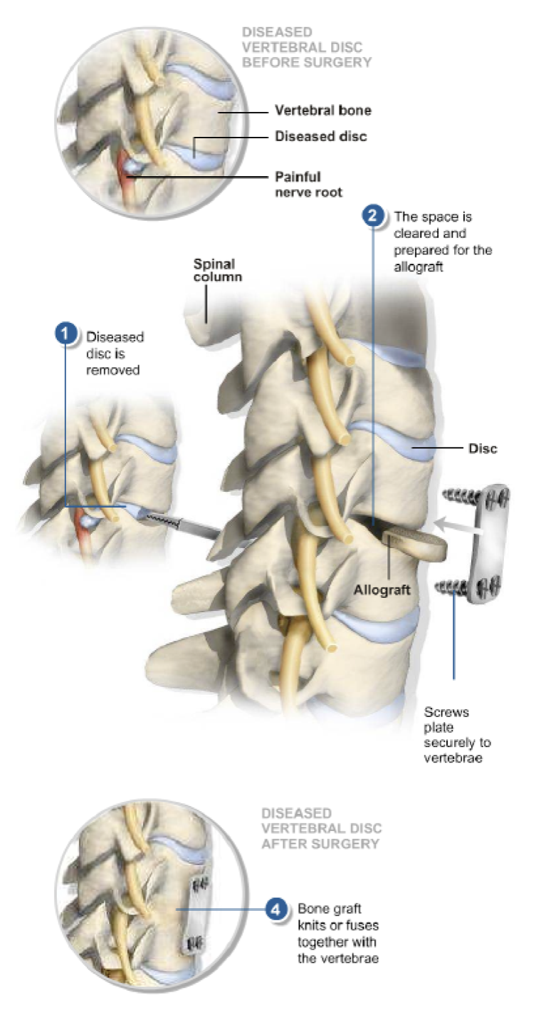 Anterior Cervical Discectomy And Fusion (ACDF)
