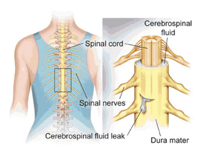 Understanding the Risks of Spine Surgery